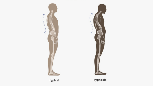 unraveling the signs and symptoms of spinal curvature