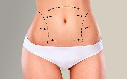 liposuction in turkey 76